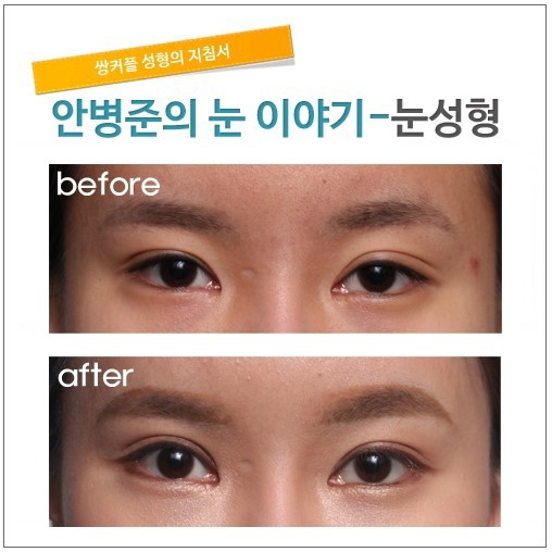 부분절개와 매몰법으로 풀려버린 눈 고치기. 관련 이미지 1