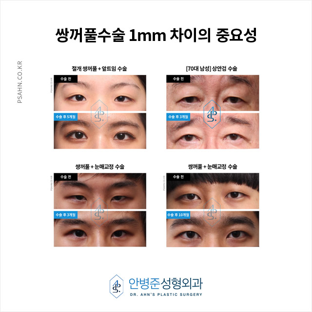 [안병준성형외과] 쌍꺼풀수술, 1mm 차이가 얼굴 조화를 바꾼다! 관련 이미지 3