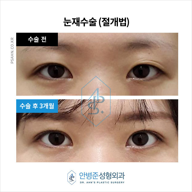 [재수술성형외과] 눈 성형 재수술, 왜 필요한가요? 관련 이미지 5
