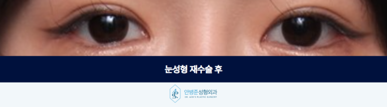 What You Should Check Before Rushing to a Ptosis Diagnosis in Revision Eye Surgery image 3