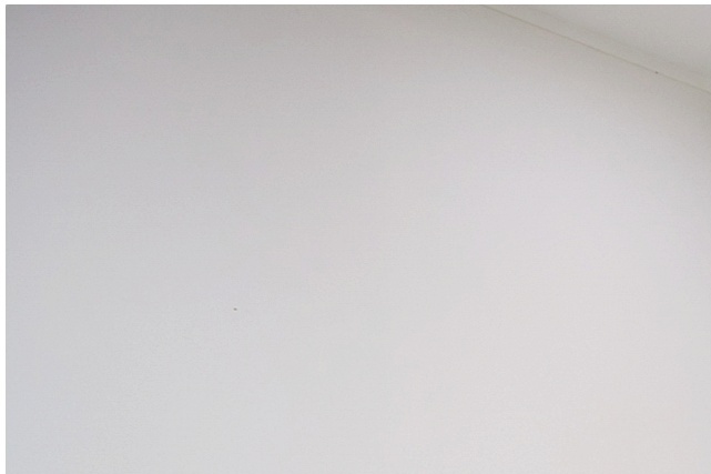 쌍꺼풀 재수술 잘하는병원 여러 번 수술한 눈일수록 이것이 필요합니다 관련 이미지 9