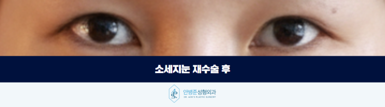 소세지눈 재수술 부기와 구분해야 하는 이유 관련 이미지 3