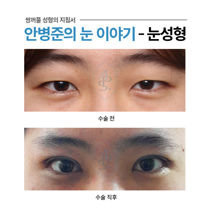 쌍꺼풀 수술에서 부기란? - 수술직후 붓기 사례 모음 관련 이미지 4