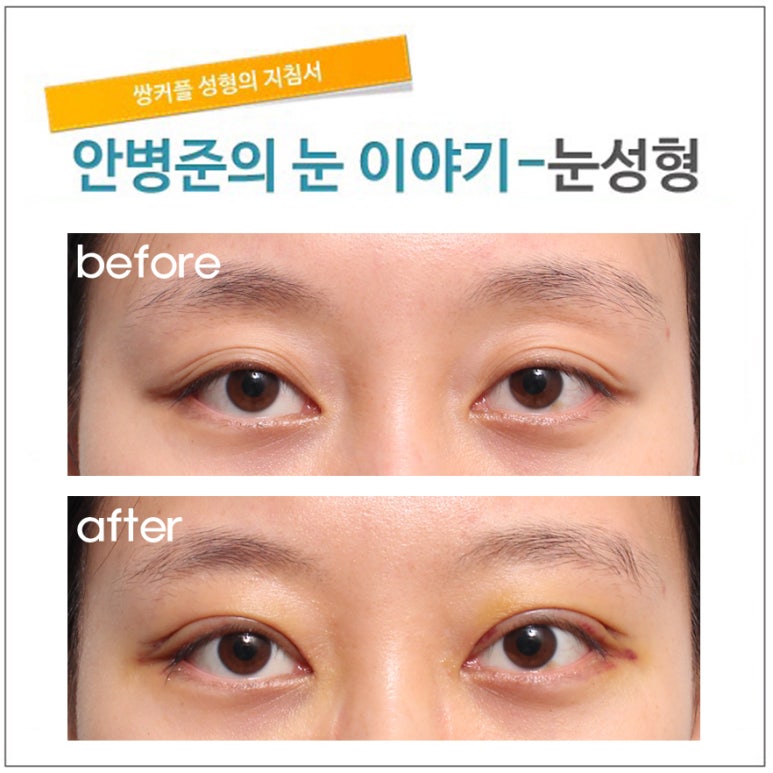 돌출눈 관련 이미지 2