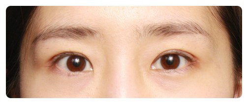 눈성형 4개월후 경과사진 관련 이미지 3