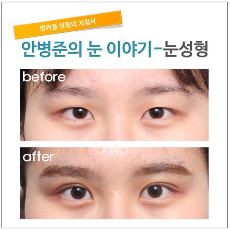 같은 듯, 다른 듯 자매의 눈(절제술,눈매교정,안검하수,피부절제,삼백안,삼백안교정) 관련 이미지 2