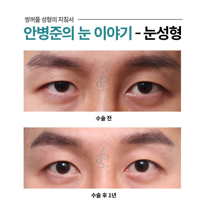 째려보이는 눈으로 보인다면? 쌍수와 눈매교정 사례 관련 이미지 1