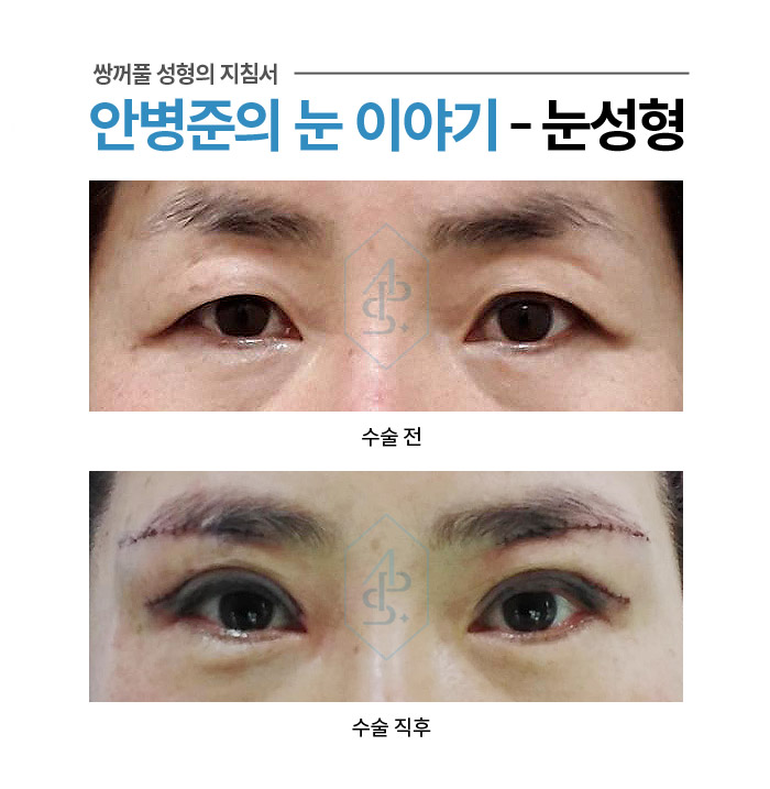 쌍꺼풀 수술에서 부기란? - 수술직후 붓기 사례 모음 관련 이미지 2
