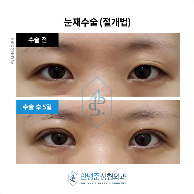 눈성형재수술,왜 필요한 걸까요? 흔한 실패 원인 분석 관련 이미지 5