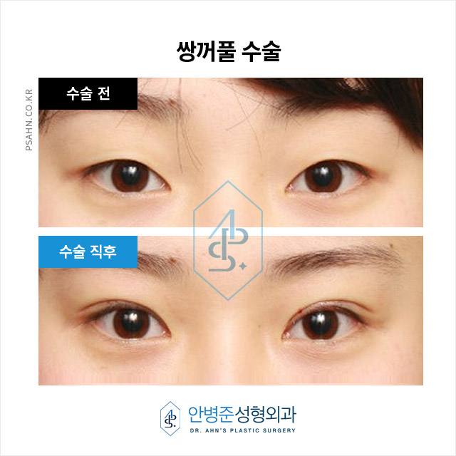 [강남성형외과] 쌍꺼풀 수술을 고민하시는 분들을 위해, 수술 전 준비부터 회복 과정까지~! 관련 이미지 3