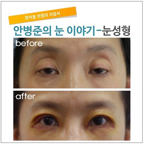 극심한 안검하수 수술후5일. 관련 이미지 1