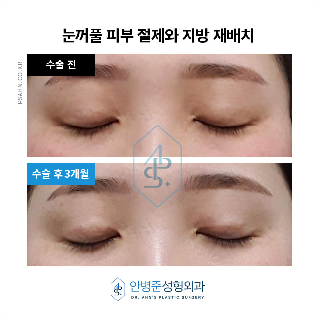 눈꺼풀 처짐,중앙부위에 지방이 없고 겹주름 수술사례 관련 이미지 7