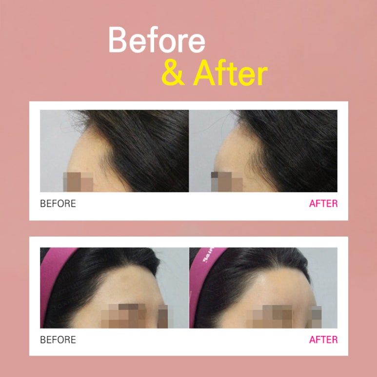 내 얼굴에 딱 맞는 이마필러 관련 이미지 5