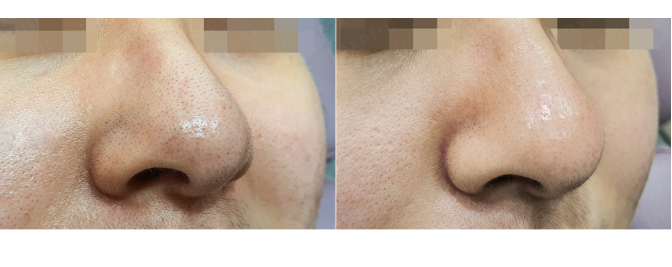 [관악구피부과] 블랙헤드집중모드 후기와 정보, 관악구피부과에서 강력추천합니다! 관련 이미지 1