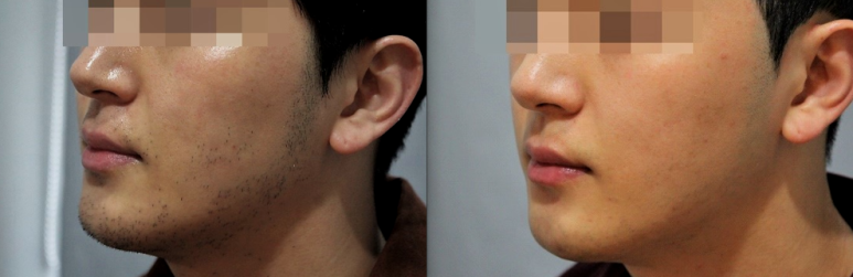 관악구피부과에 남자제모로 수염자국없앤 후기 관련 이미지 4
