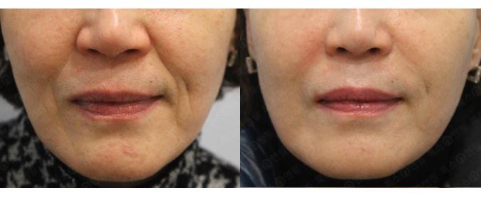 깊어도 너무 깊은 팔자주름! 서울대입구피부과에서 팔자주름 쫘악 펴드립니다!! 팔자주름 후기와 정보! 관련 이미지 1