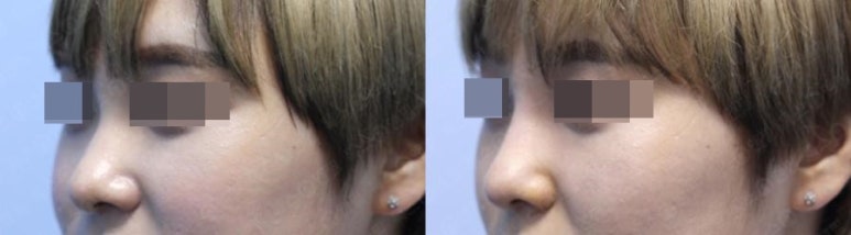 서울대입구역피부과 낮은 콧대 고민은 여기서 해결! 관련 이미지 2