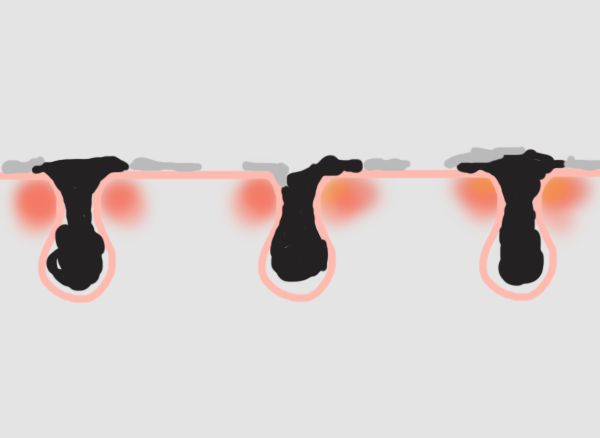 서울대입구피부과 보기 싫은 여드름 치료 뉴 알라딘필링으로 깨끗하게 관련 이미지 3