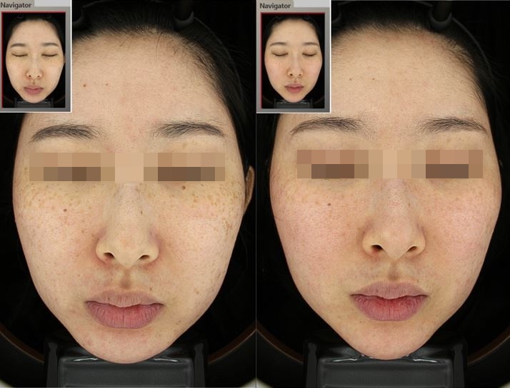 관악구피부과에서 색소집중모드로 주근깨,잡티 완벽제거한 후기(내돈내산,주근깨없애는법) 관련 이미지 4