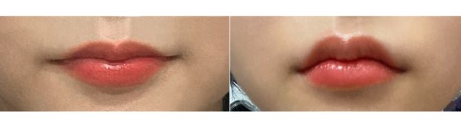 서울대입구역피부과에서 제대로 입술필러 맞은 후기 (내돈내산,가격정보,후기) 관련 이미지 3