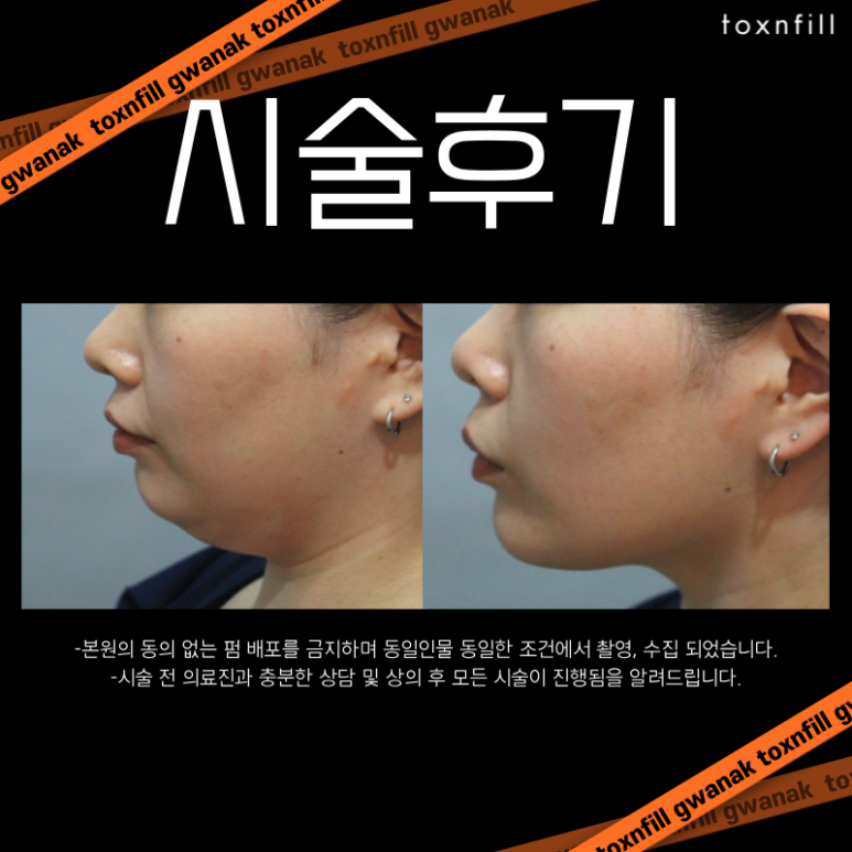 신림 인모드 두툼한 이중턱과 볼살때문에 고민이라면 관련 이미지 5