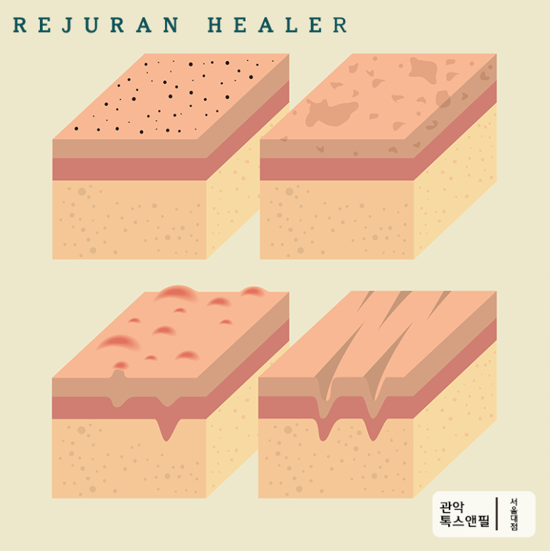 서울대입구 스킨부스터 리쥬란힐러 효과는? 관련 이미지 2