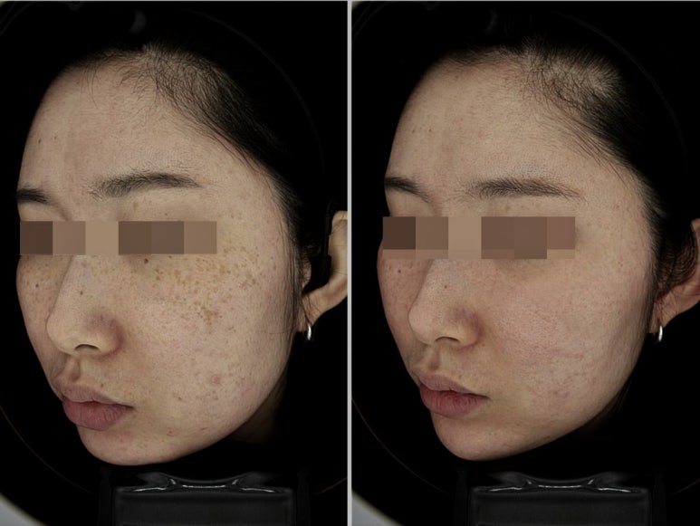 서울대입구역 피부과 주근깨제거 잘하는 곳! 관련 이미지 3