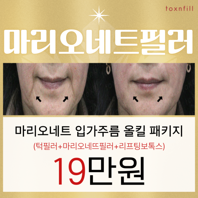 [톡스앤필서울대점] 이달의 필러이벤트! 마리오네트필러로 노화된 얼굴 되돌리기!! 관련 이미지 1