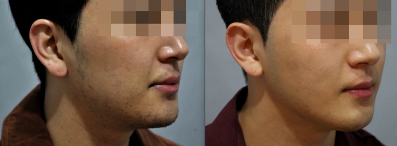 관악구피부과에 남자제모로 수염자국없앤 후기 관련 이미지 5