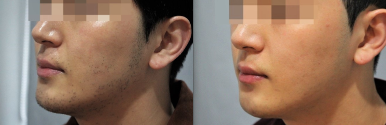 서울대입구역피부과에서 남자수염제모 할인혜택받음 관련 이미지 3