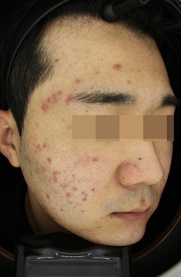 서울대입구역 피부과 여드름치료 후기 5주간의 여정! 관련 이미지 5