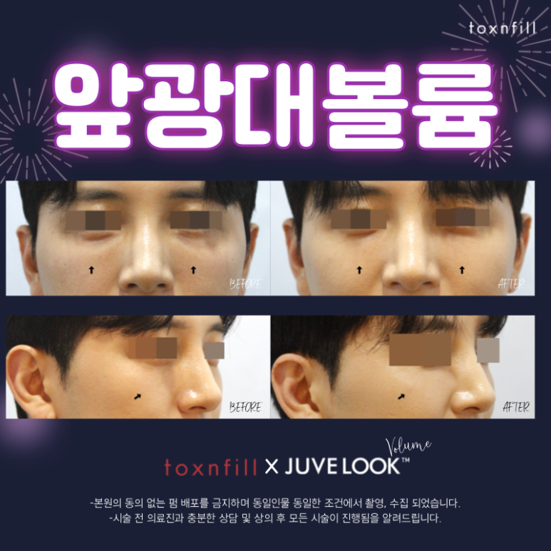 구로피부과 꺼진앞광대에 자연스러운 볼륨채우기 관련 이미지 4