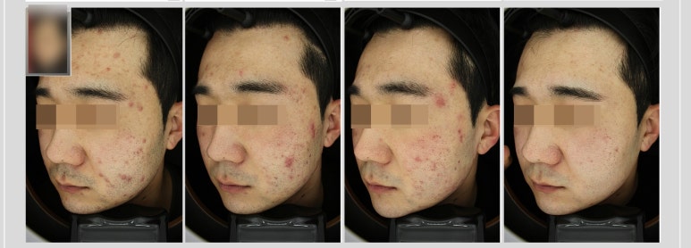 관악구피부과에서 여드름치료 받은 후기 (5주간 프로젝트) 관련 이미지 4