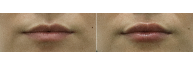 [톡스앤필관악점] 입술필러?어디서해?톡스앤필에서해!! 관련 이미지 2