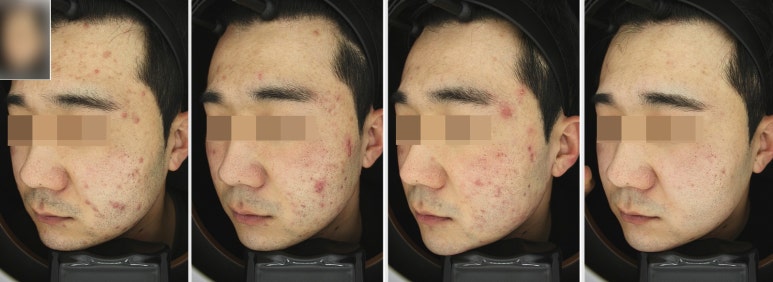 관악구피부과에서 여드름 치료한 후기 관련 이미지 2