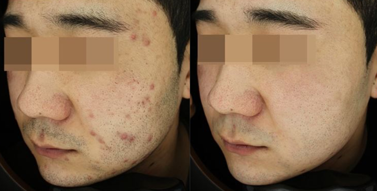 서울대입구역 피부과 여드름치료는 이곳으로 추천! 관련 이미지 5