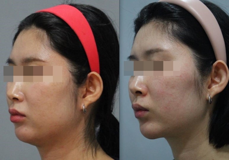 관악구피부과에서 인모드로 v라인,달걀형얼굴만든후기!(내돈내산) 관련 이미지 4
