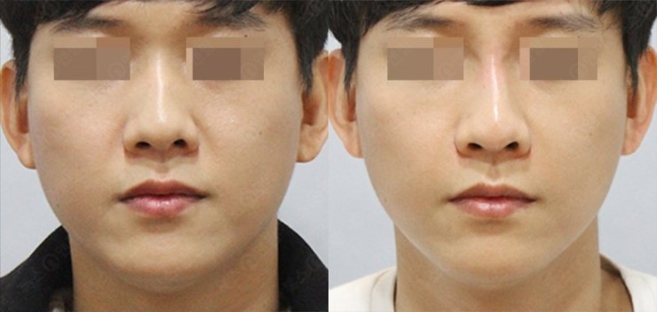 서울대입구역피부과에서 턱보톡스 맞고 v라인 얻은후기!(내돈내산,후기,가격) 관련 이미지 3