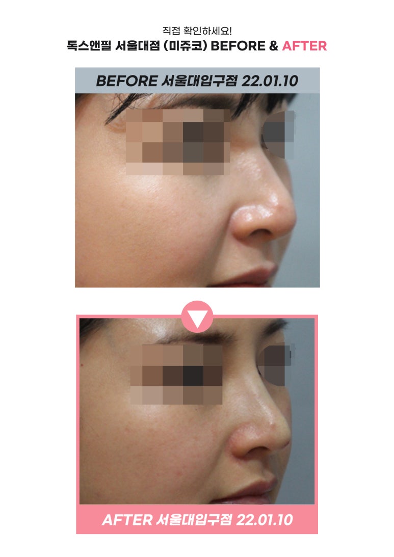 서울대입구역피부과 미쥬코 코필러로 아름다운 코라인을 관련 이미지 7