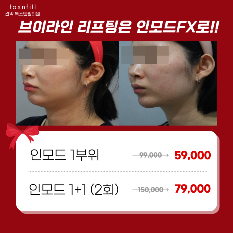 서울대입구역피부과 맞춤 v라인 리프팅엔 인모드 관련 이미지 1