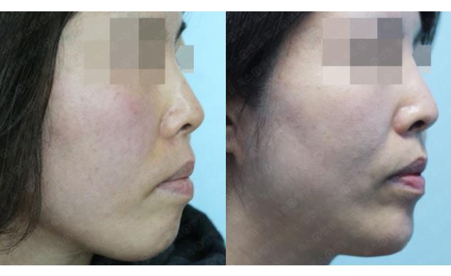 관악구피부과에서 추천하는 턱필러 효과 관련 이미지 2