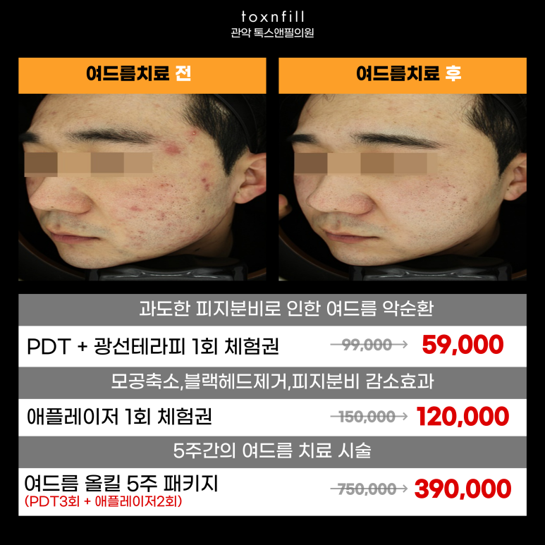 관악구 피부과에서 여드름치료받고 자신감되찾기! 관련 이미지 5