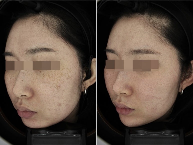 서울대입구역피부과 주근깨와 기미 제거 한번에해결 관련 이미지 3