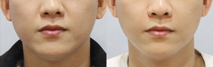 서울대입구역 피부과 v라인의 시작 턱보톡스 관련 이미지 3