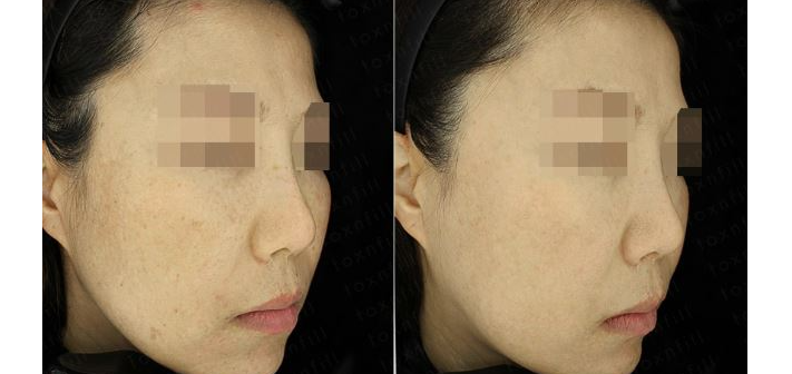 관악구피부과에서 화사한 피부를 주는 관리방법 바로 백옥토닝&백옥토닝 가격정보후기 관련 이미지 6