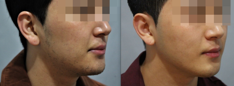 서울대입구역피부과에서 남자수염제모 할인혜택받음 관련 이미지 4