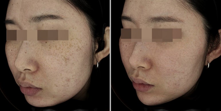 서울대입구역 피부과 주근깨,기미 제거에는? 관련 이미지 2