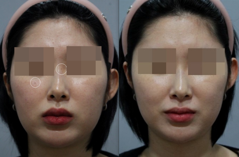 서울대입구역피부과에서 점제거 한 후기 관련 이미지 3