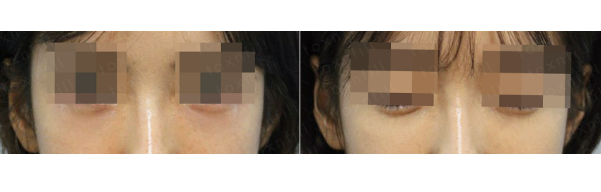 서울대입구역피부과에서 애교필러받고 얼굴에 자신감 찾은 후기! 애교필러 과연 괜찮을까?(내돈내산) 관련 이미지 1