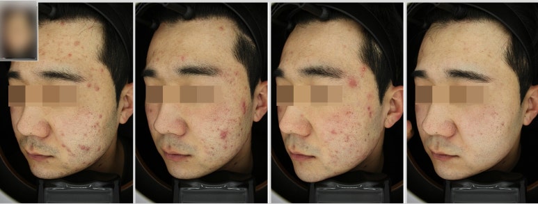 관악구 피부과에서 여드름치료받고 자신감되찾기! 관련 이미지 2